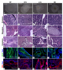 Feeder free derivation of iPSC lines from human dermal fibroblasts isolated from patients with retinal degenerative disease. A-D: Microscopic analysis of human retinal disease specific iPSCs generated and expanded for 10 passages on SynthemaxTM cell culture surfaces (RP = Retinitis Pigmentosa, STG = Stargardt Disease, LCA - Leber Congenital Amaurosis, BD = Batten Disease). Histological analysis of retinal disease specific iPSC derived teratomas for production of cells/tissues specific to ectodermal (E-H), mesodermal (I-L), and endodermal (M-P) germ layers. Q-X: Immunocytochemical analysis of retinal disease specific iPSC derived teratomas with antibodies targeted against GFAP (ectodermal Q-T) and αSMA, (mesodermal U-X). Scale bar A-D = 400μm; Scale bar Q-X = 200μm. Feeder free derivation of iPSC lines from human dermal fibroblasts isolated from patients with retinal degenerative disease.