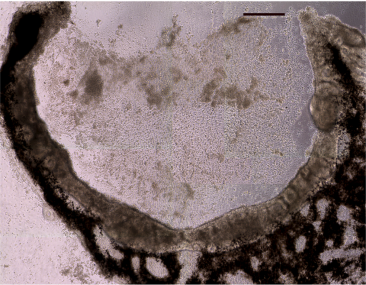 Differentiation of human USH2A-associated iPSCs into eyecup-like structures. As shown below at 150 days post-differentiation, complete eyecup like structures with clearly defined neural retina and RPE layers can be generated from patient specific iPSCs. Differentiation of human USH2A-associated iPSCs into eyecup-like structures